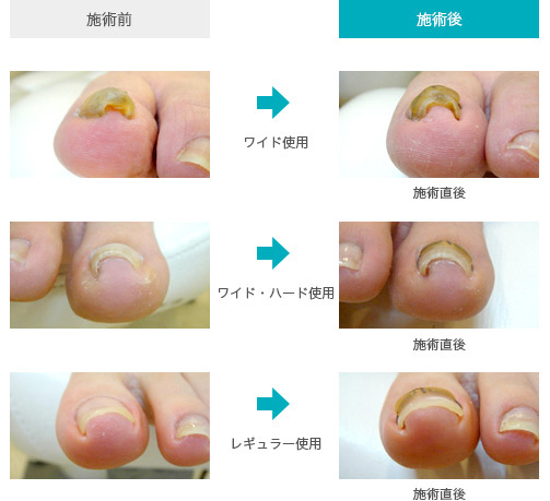 巻き爪矯正器具 コレクティオチタン 医療機関の方へ 株式会社リフレプロジャパン
